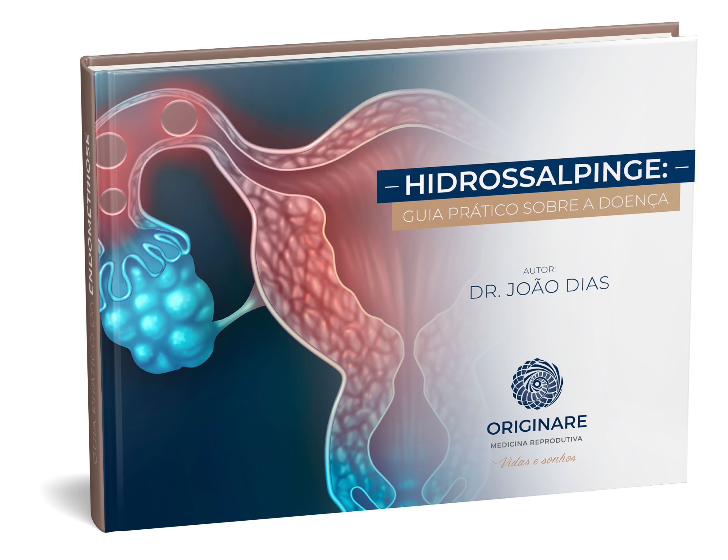 E-book | Hidrossalpinge: guia prático sobre a doença